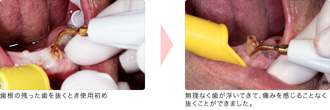バリオサージ:歯根の残った歯を抜くとき使用初め→無理なく歯が浮いてきて、痛みを感じることなく抜くことができました。