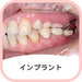インプラント