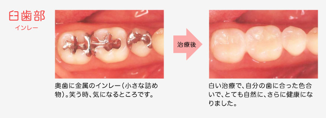 前歯部 ジャケット冠