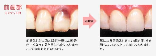 臼歯部 インレー