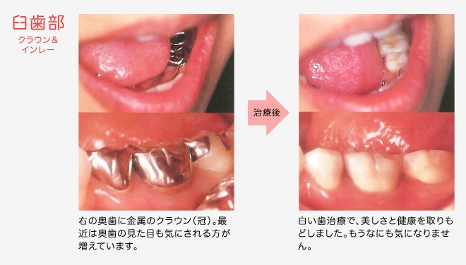 臼歯部 クラウン&インレー