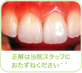 どの歯を治療したかわかりますか? 正解は当院スタッフにおたずねください^^